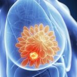 breast-cancer-tumor